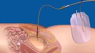 Cystotomy | PPTX