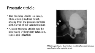Prostatic utricle
• The prostatic utricle is a small,
blind-ending midline pouch
arising from the prostatic urethra
at the level of the verumontanum
• A large prostatic utricle may be
associated with urinary retention,
stasis, and infection
 
