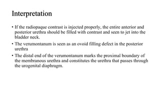 Interpretation
• If the radiopaque contrast is injected properly, the entire anterior and
posterior urethra should be filled with contrast and seen to jet into the
bladder neck.
• The verumontanum is seen as an ovoid filling defect in the posterior
urethra
• The distal end of the verumontanum marks the proximal boundary of
the membranous urethra and constitutes the urethra that passes through
the urogenital diaphragm.
 