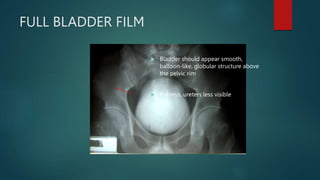 FULL BLADDER FILM
 Bladder should appear smooth,
balloon-like, globular structure above
the pelvic rim
 Kidneys, ureters less visible
 