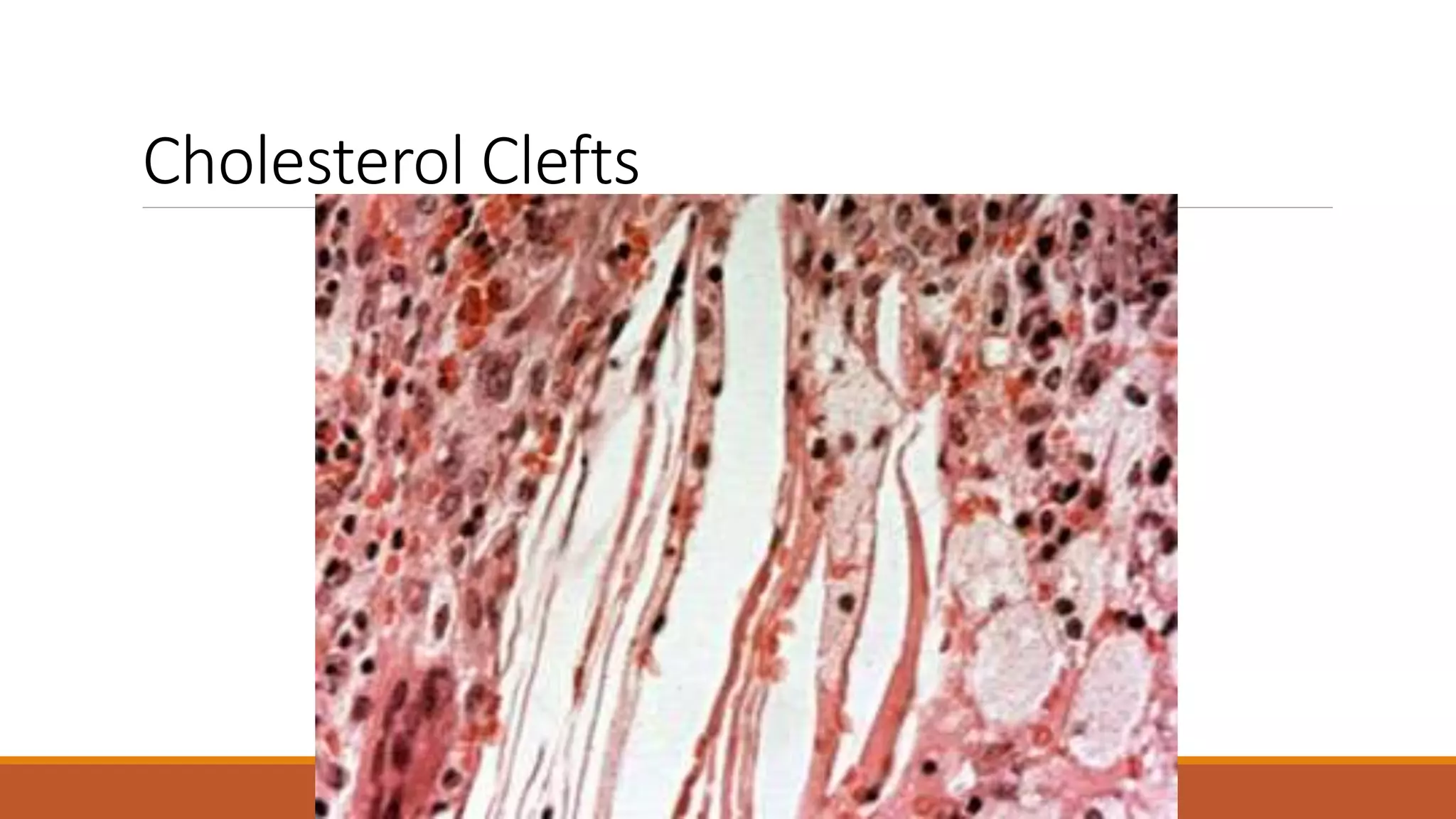 Cholesterol Clefts