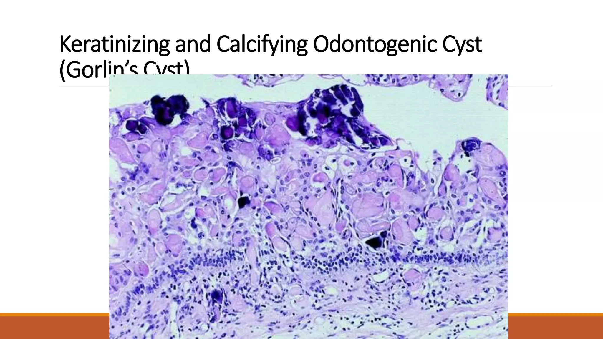 Keratinizing and Calcifying Odontogenic Cyst
(Gorlin’s Cyst)