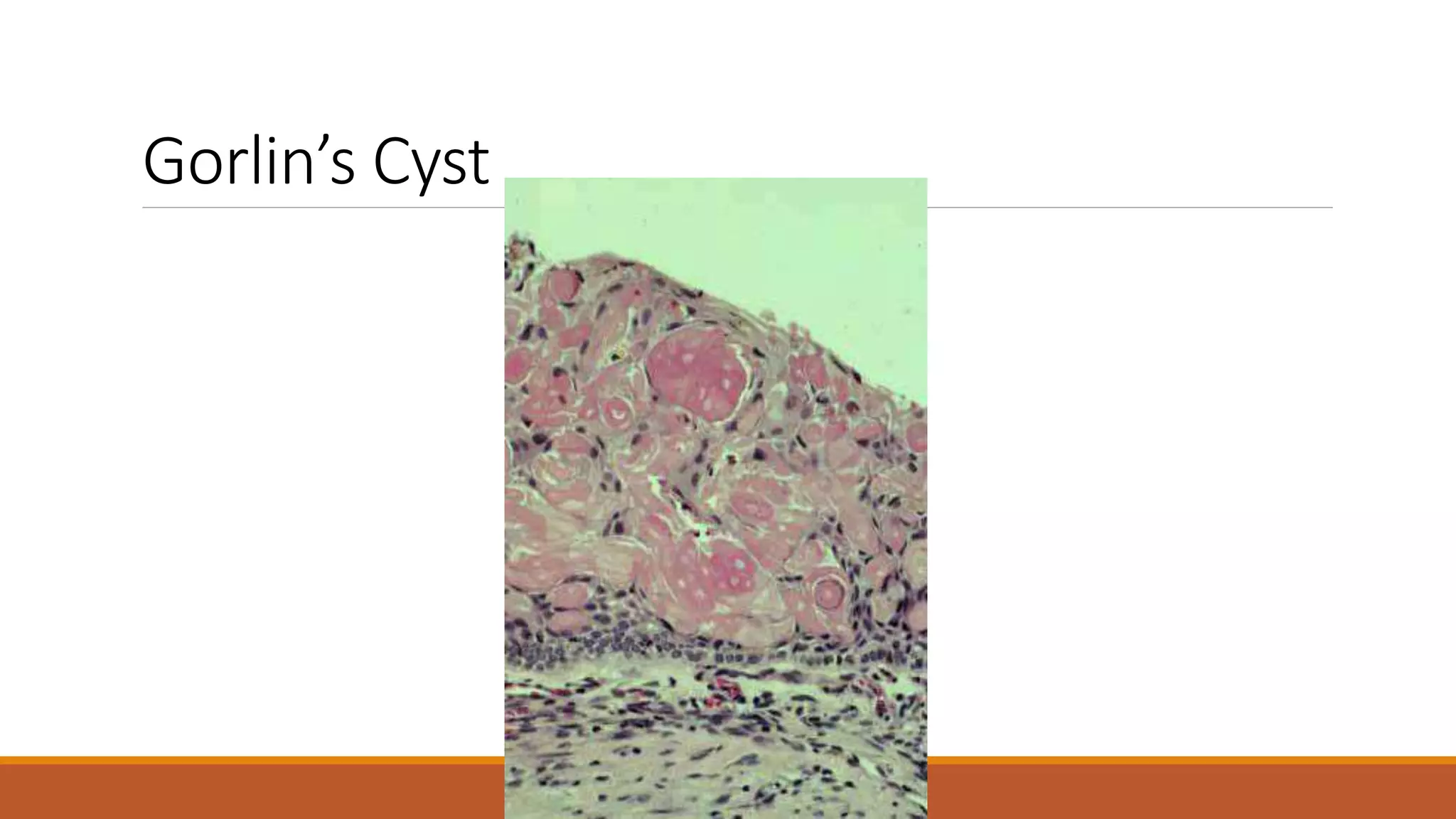 Gorlin’s Cyst
