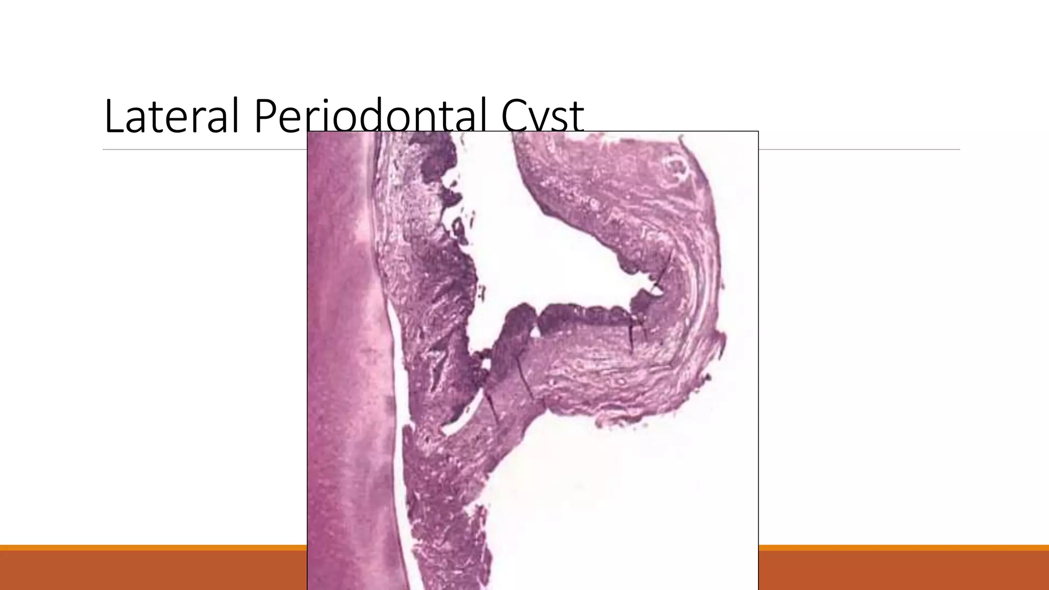 Lateral Periodontal Cyst