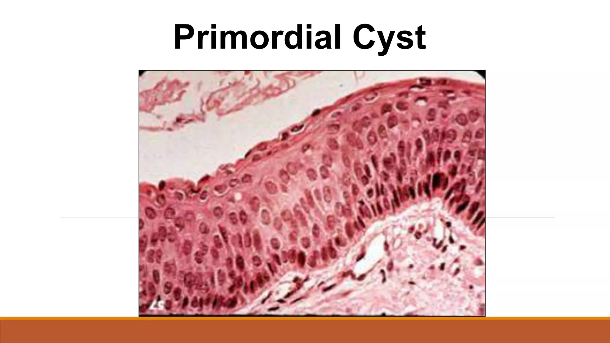 Primordial Cyst