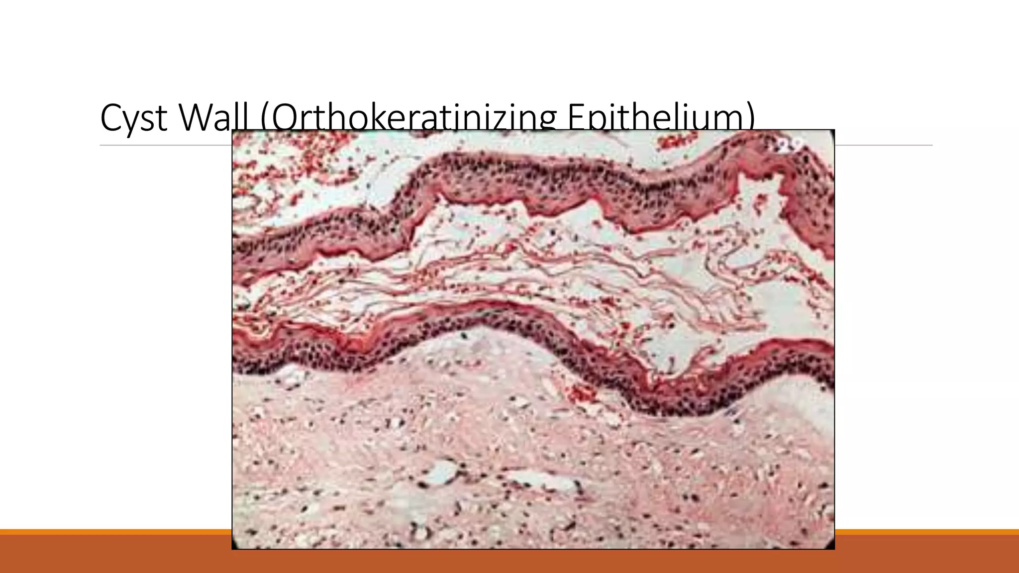 Cyst Wall (Orthokeratinizing Epithelium)