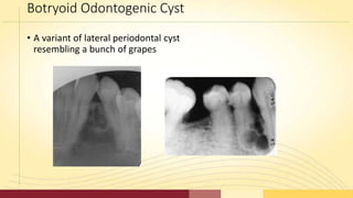 Cysts | PPTX