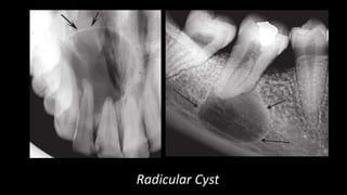 Radicular Cyst
 