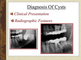 Cysts Expression Cysts.ppt