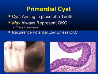 2020
Primordial CystPrimordial Cyst
 Cyst Arising in place of a ToothCyst Arising in place of a Tooth
 MayMay Always Represent OKCAlways Represent OKC
 This is ControversialThis is Controversial
 Recurrence Potential Low Unless OKCRecurrence Potential Low Unless OKC
 