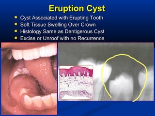 Eruption CystEruption Cyst
 Cyst Associated with Erupting ToothCyst Associated with Erupting Tooth
 Soft Tissue Swelling Over CrownSoft Tissue Swelling Over Crown
 Histology Same as Dentigerous CystHistology Same as Dentigerous Cyst
 Excise or Unroof with no RecurrenceExcise or Unroof with no Recurrence
 