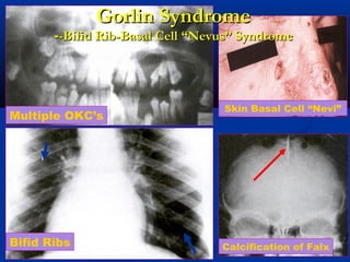 4444Calcification of Falx
Skin Basal Cell “Nevi”
Multiple OKC’s
Gorlin SyndromeGorlin Syndrome
-Bifid Rib-Basal Cell “Nevus” Syndrome-Bifid Rib-Basal Cell “Nevus” Syndrome--
Bifid Ribs
 