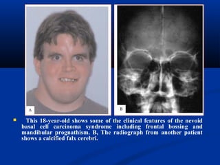  This 18-year-old shows some of the clinical features of the nevoid
basal cell carcinoma syndrome including frontal bossing and
mandibular prognathism. B, The radiograph from another patient
shows a calcified falx cerebri.
 