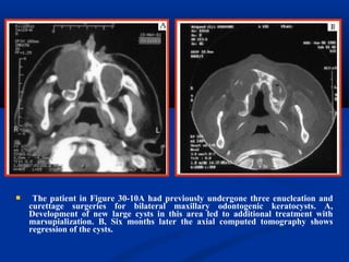  The patient in Figure 30-10A had previously undergone three enucleation and
curettage surgeries for bilateral maxillary odontogenic keratocysts. A,
Development of new large cysts in this area led to additional treatment with
marsupialization. B, Six months later the axial computed tomography shows
regression of the cysts.
 