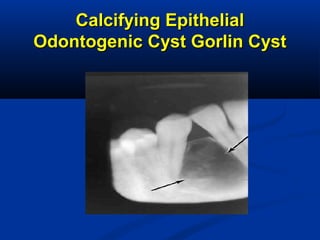 Calcifying EpithelialCalcifying Epithelial
Odontogenic Cyst Gorlin CystOdontogenic Cyst Gorlin Cyst
 