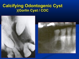 Calcifying Odontogenic CystCalcifying Odontogenic Cyst
(Gorlin Cyst / COC(Gorlin Cyst / COC((
 