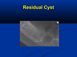 Residual CystResidual Cyst
 