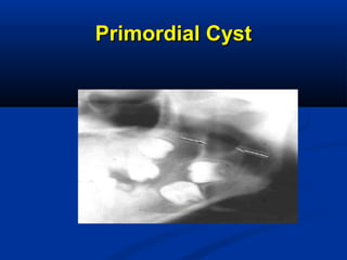 Primordial CystPrimordial Cyst
 