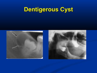 Dentigerous CystDentigerous Cyst
 
