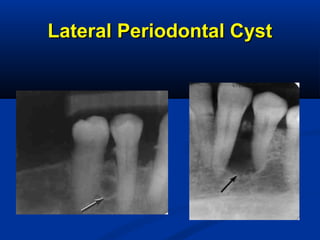 Lateral Periodontal CystLateral Periodontal Cyst
 