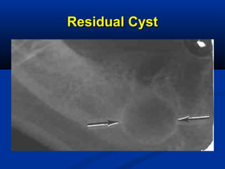 Residual CystResidual Cyst
 