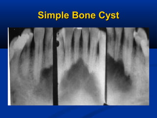 Simple Bone CystSimple Bone Cyst
 