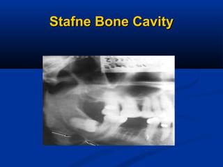 Stafne Bone CavityStafne Bone Cavity
 