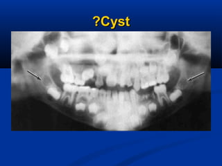 CystCyst??
 
