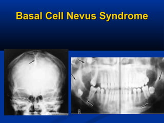 Basal Cell Nevus SyndromeBasal Cell Nevus Syndrome
 