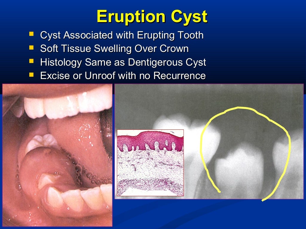 Odontogenic Cysts