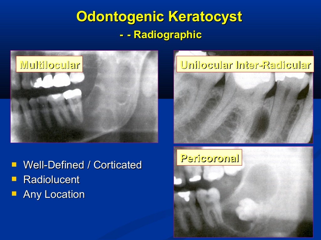 Odontogenic Cysts