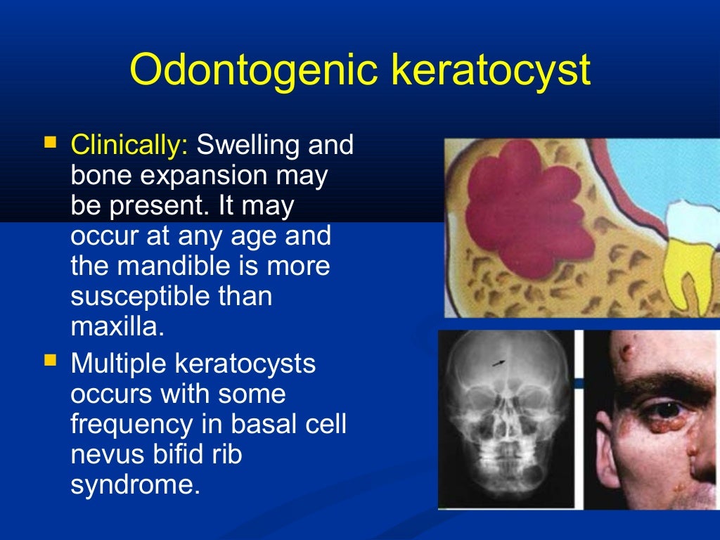 Odontogenic Cysts