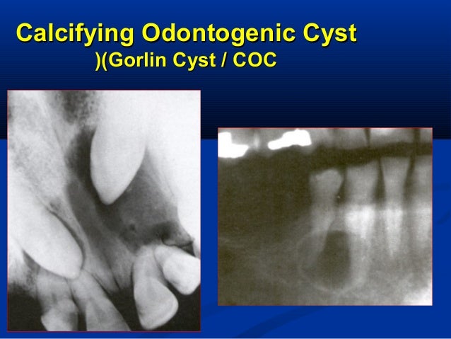 Odontogenic Cysts