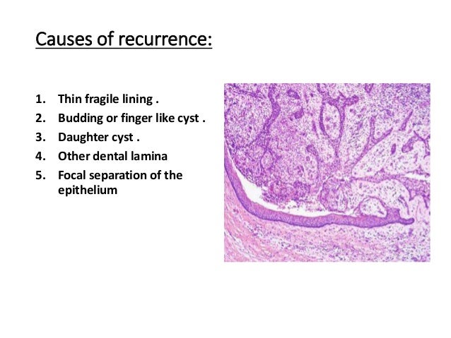 Cysts in children