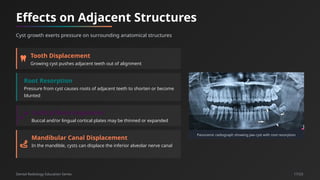 Cysts in Dental Radiography_ Classification and Radiographic Features.pptx