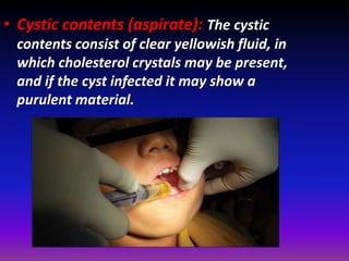 Cysts in orofacial region | PPSX