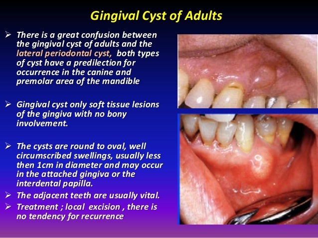 gingival curettage