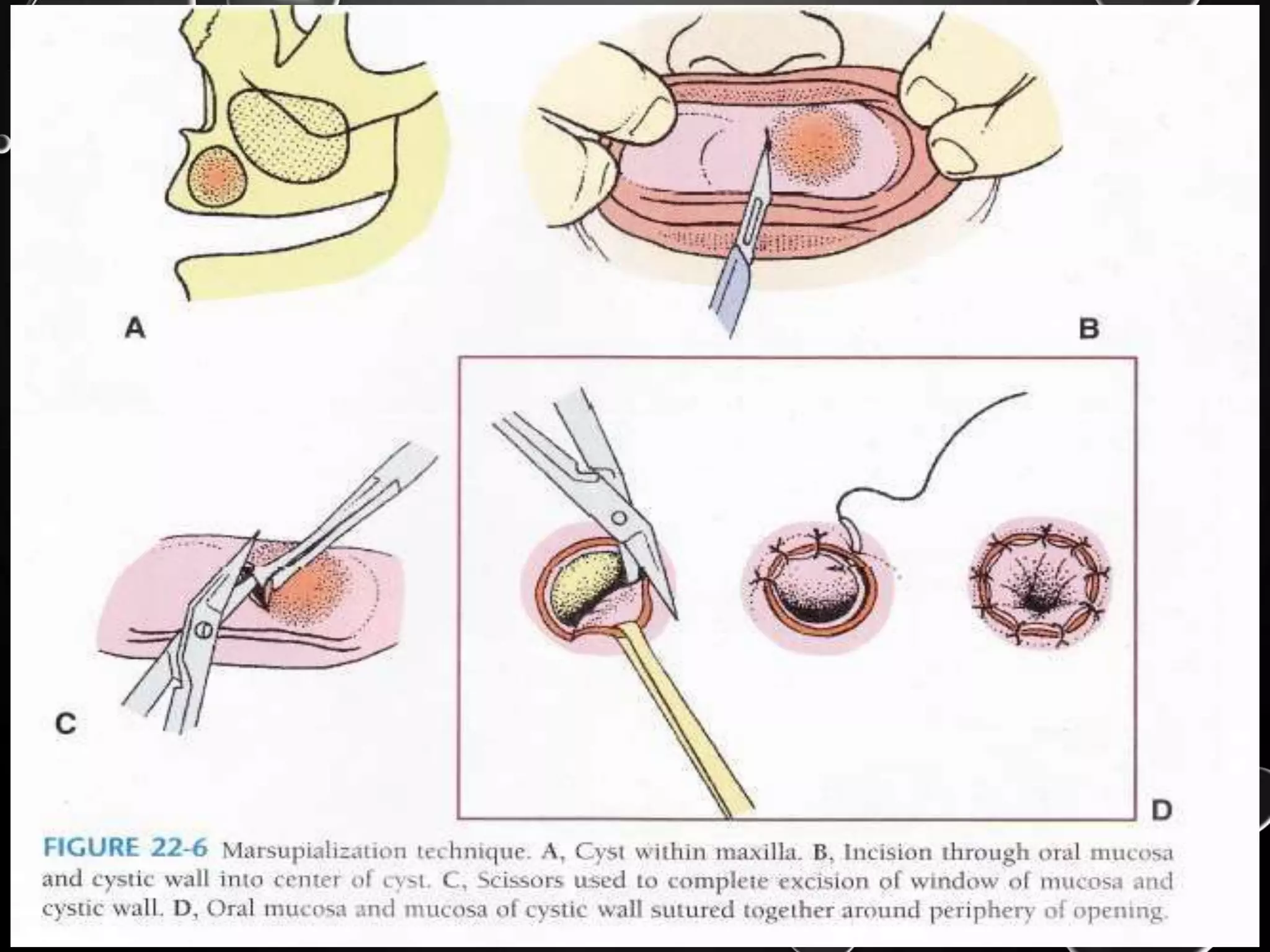 Cysts of jaw- management oral and maxillofacial surgery | PPTX