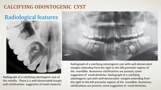 Cysts of oral and maxillofacial region by dr. maryam salman | PPTX