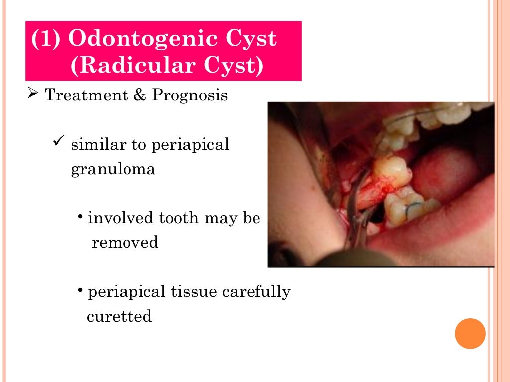 Cysts of oral region (5)