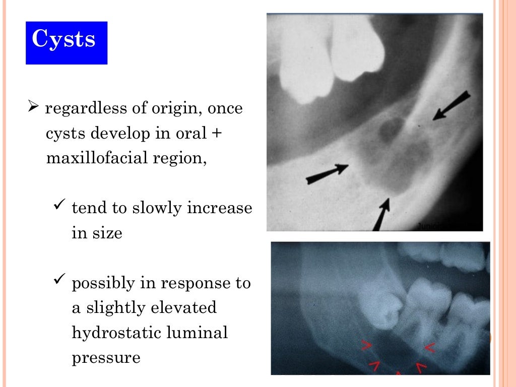 Cysts of oral region (5)