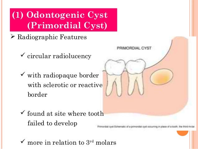 Cysts of oral region (5)