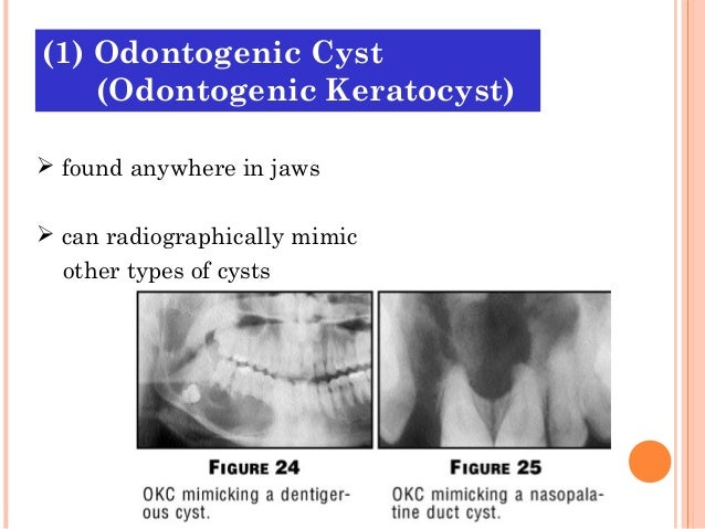 Cysts of oral region (5)