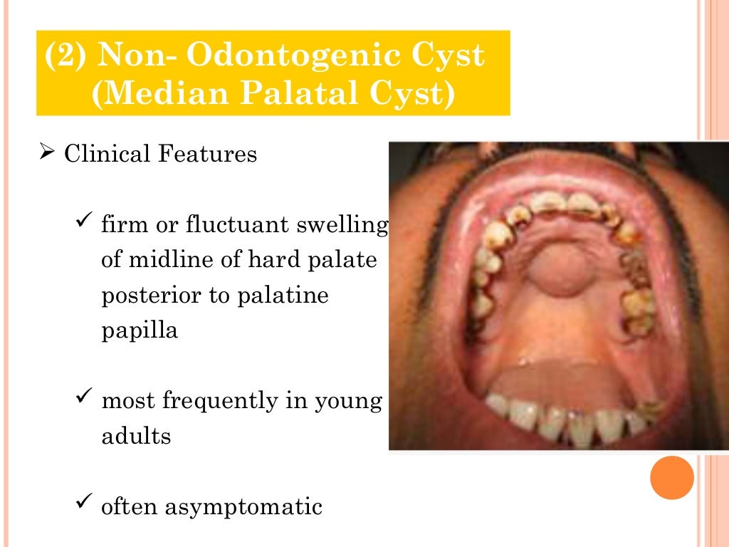 Cysts of oral region (5)
