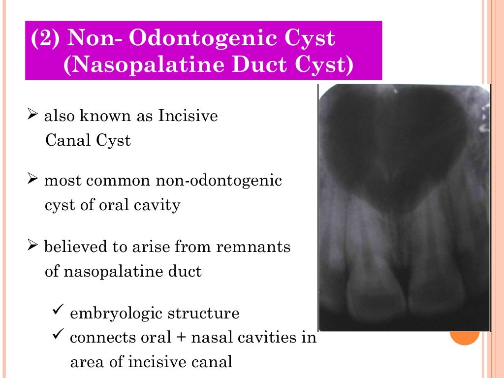Cysts of oral region (5)
