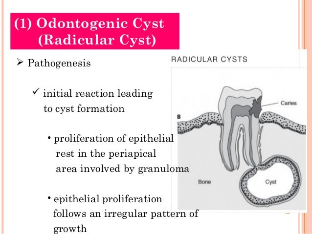 Cysts of oral region (5)