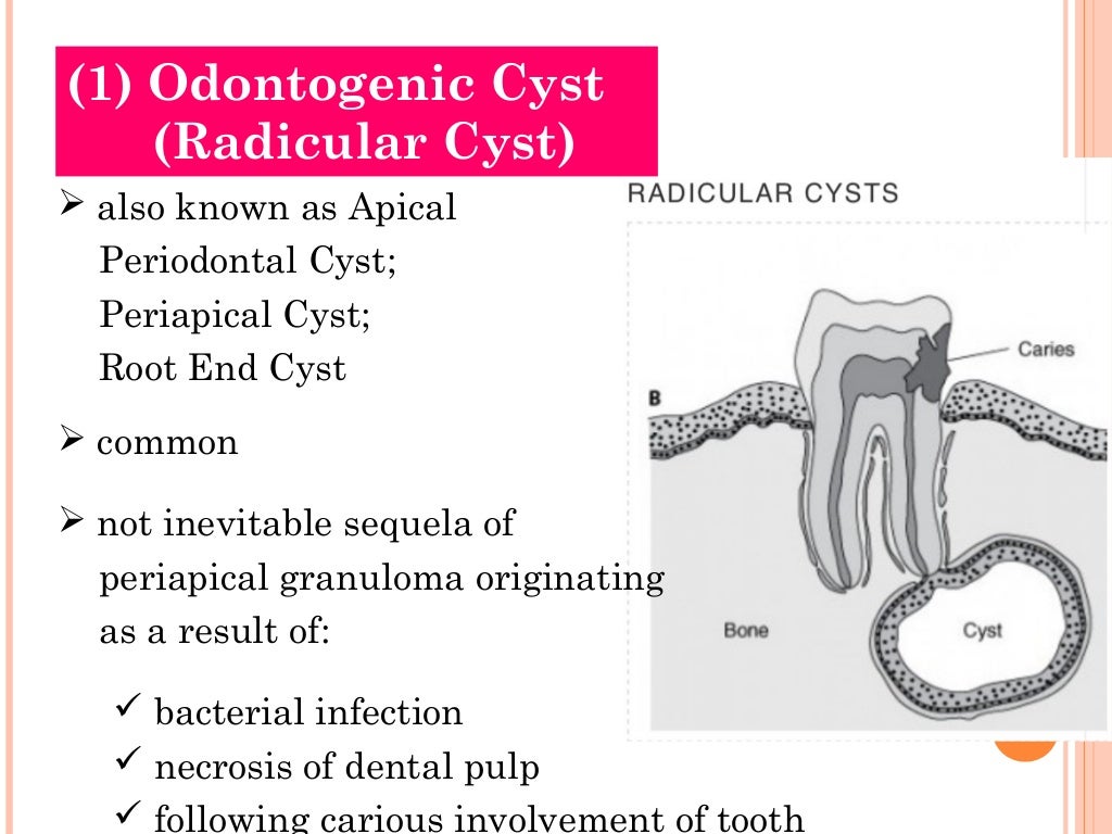 Cysts of oral region (5)