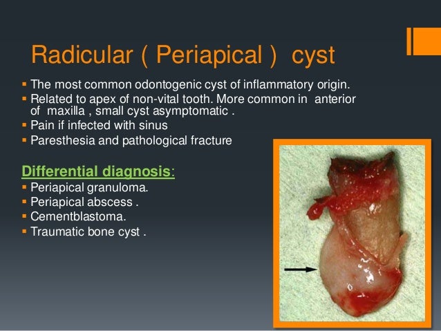 Cysts of oral regions