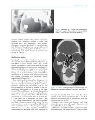 Cysts of the oral and maxillofacial regions -spear.seight_(2007) | PDF