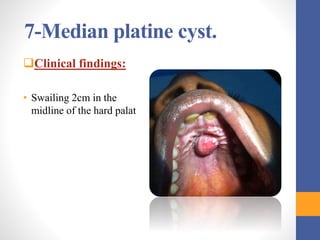 Cysts and tumors in pediatric dentistry | PPTX